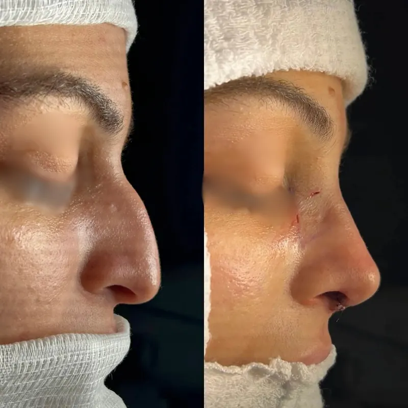 Rinoplastia, perfil do paciente antes e depois da cirurgia