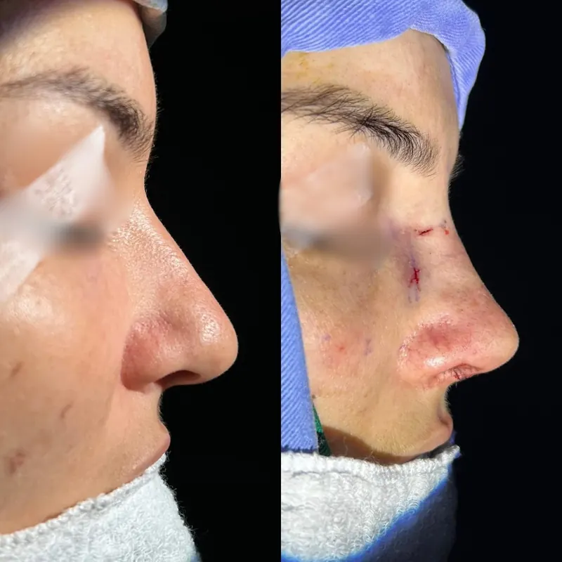 Rinoplastia, perfil do paciente antes e depois da cirurgia