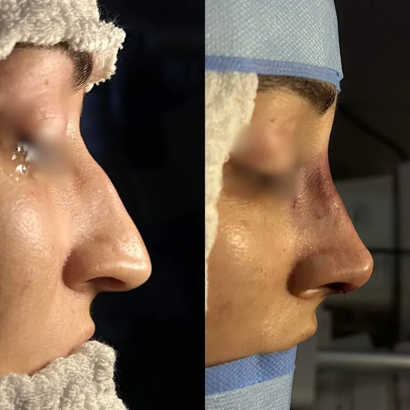 Rinoplastia, perfil do paciente antes e depois da cirurgia