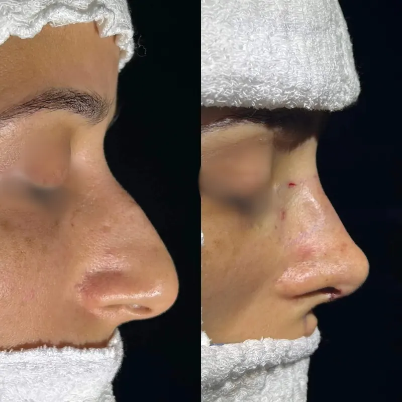 Rinoplastia, perfil do paciente antes e depois da cirurgia
